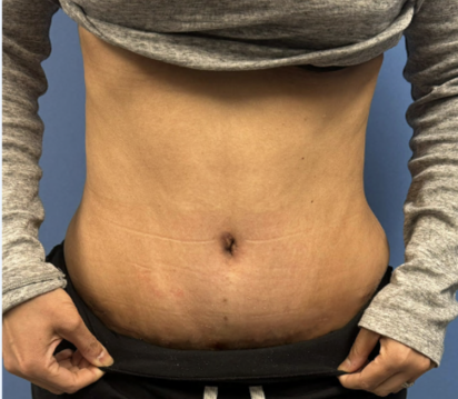 Tummy-Tuck-With-Liposuction--Case-Study-5652 | After Liposuction